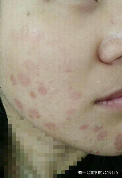 脸上真菌感染图片,面部真菌感染症状解析与防治策略