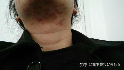 脸上真菌感染图片,面部真菌感染症状解析与防治策略
