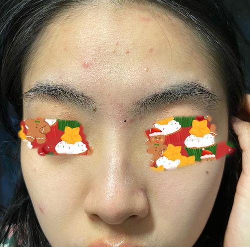 脸上过敏的图片,图解脸部过敏症状解析