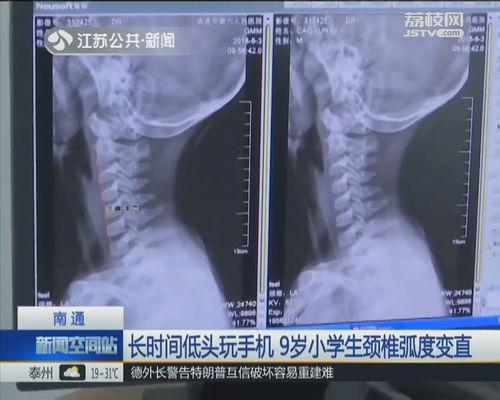 儿童颈椎突出图片大全,图片解析与预防措施