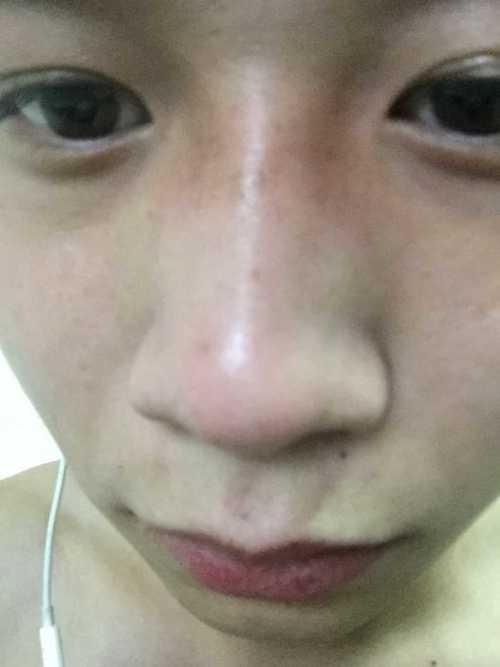 鼻梁中间发黑图片,探寻健康与美容的平衡之道