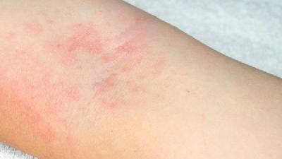 麻珍早期症状图片大全,识别与预防的关键时刻