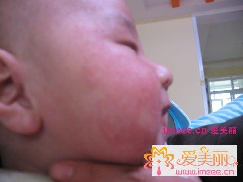 麻珍早期症状图片大全,识别与预防的关键时刻