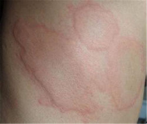 麻珍早期症状图片大全,识别与预防的关键时刻