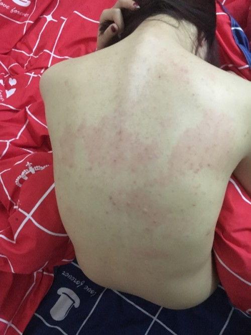 怀孕身上起红疙瘩图片